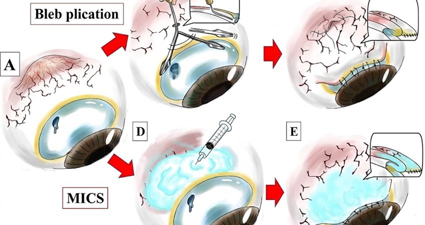 Bleb Revision & Repair