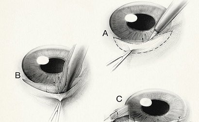 Bleb Revision & Repair