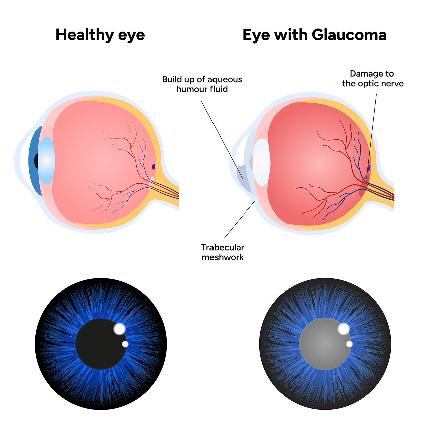Comprehensive Glaucoma Work up