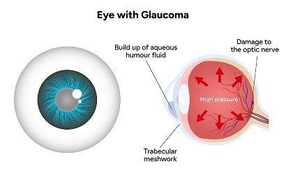 Comprehensive Glaucoma Work up