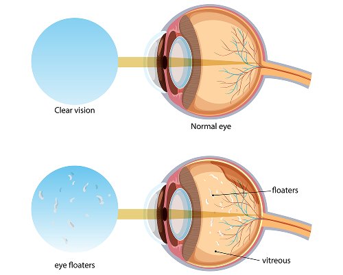 Glaucoma Screening - Dr. Amola Gandhi