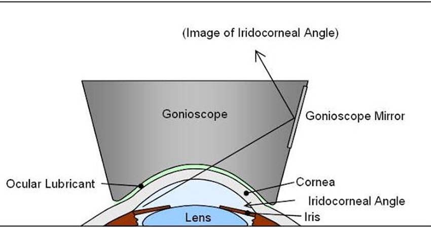 Gonioscopy For Glaucoma