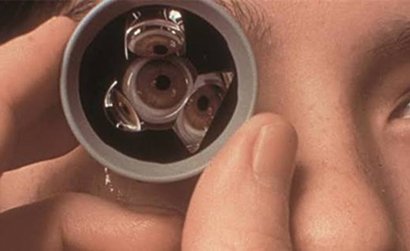Gonioscopy For Glaucoma