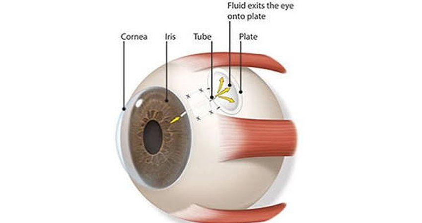 Implant Surgery (Ahmed Glaucoma Valve)
