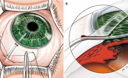 Implant Surgery (Ahmed Glaucoma Valve)