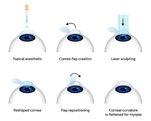 Laser Glaucoma Treatment