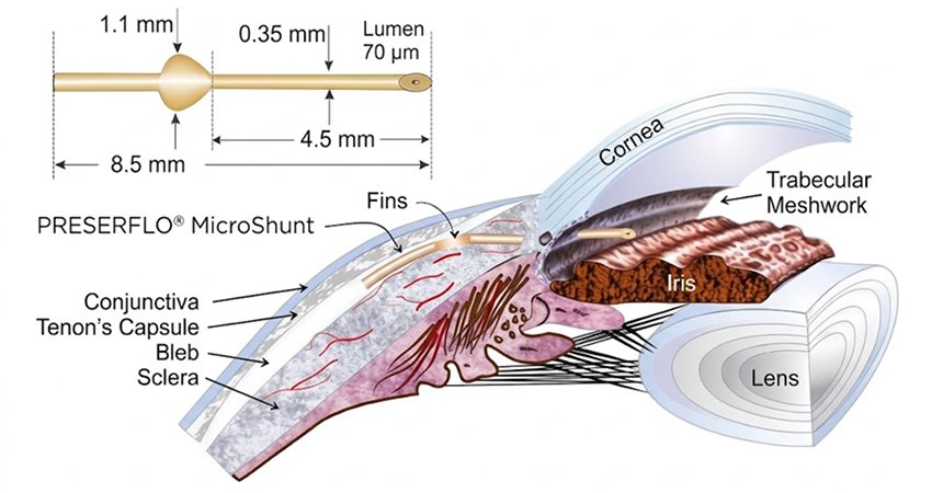 Minimally Invasive Glaucoma Surgery (MIGS) (KDB & GATT)