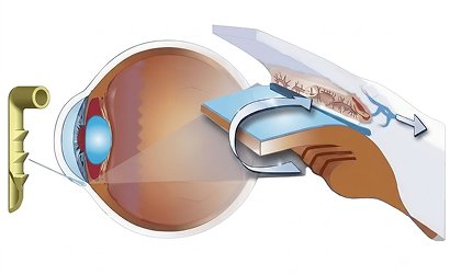 Minimally Invasive Glaucoma Surgery (MIGS) (KDB & GATT)