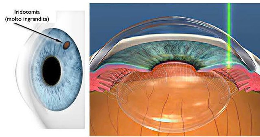N D YAG Laser (for Peripheral Iridotomy)