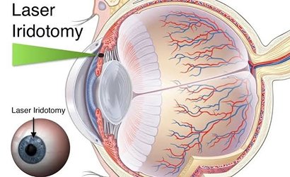 N D YAG Laser (for Peripheral Iridotomy)