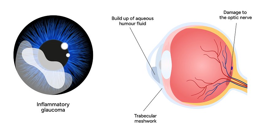 Perimetry For Glaucoma