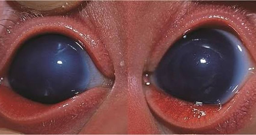 Trab + Trab for Pediatric Glaucoma