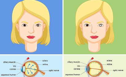 Trab + Trab for Pediatric Glaucoma