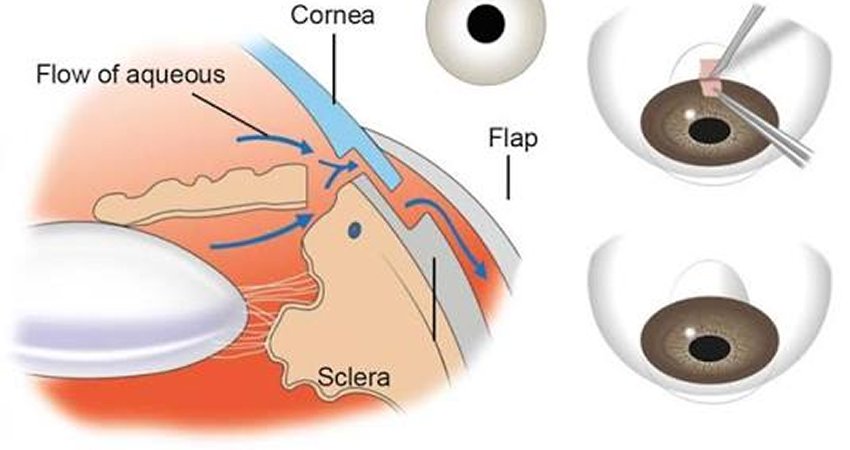 Trabeculectomy +/- Mitomycine - C for Adult Glaucoma