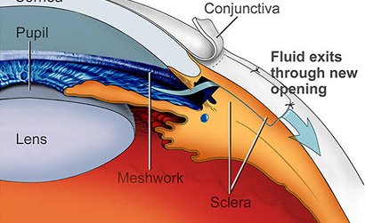 Trabeculectomy +/- Mitomycine - C for Adult Glaucoma