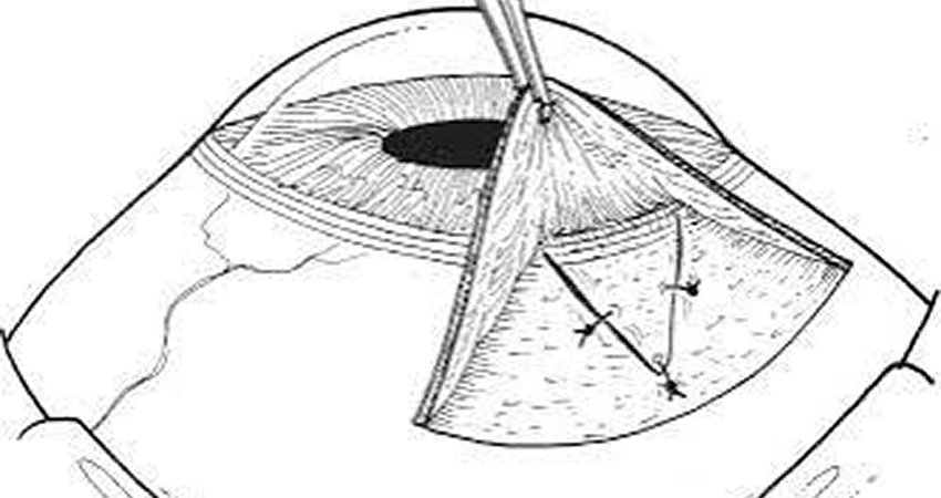 Trabeculotomy
