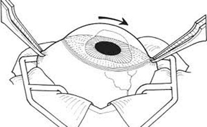Trabeculotomy